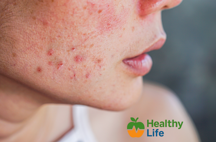 Acne: Causes, Care Tips, and Myths Debunked